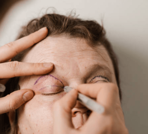 Professional Blepharoplasty Consultations Essex Safe and Informed Decisions