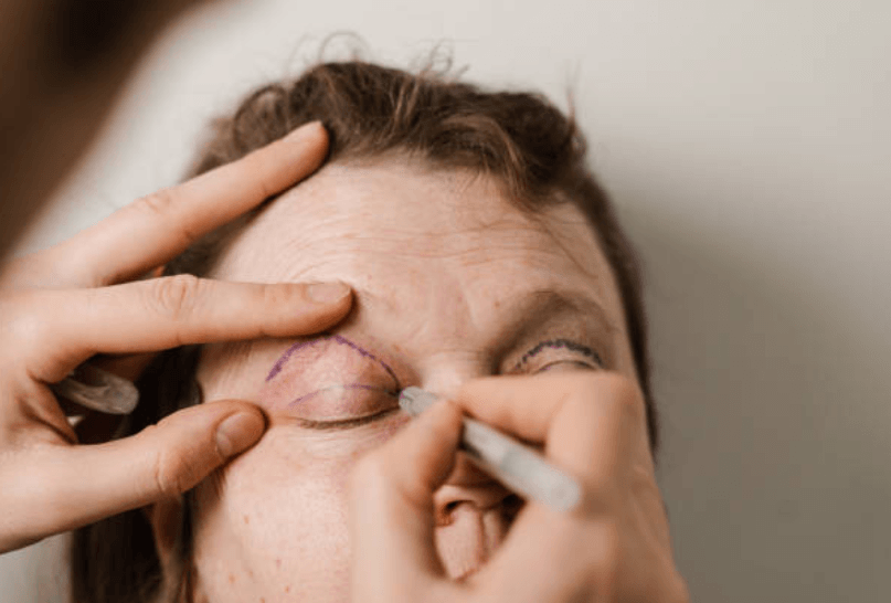 Professional Blepharoplasty Consultations Essex Safe and Informed Decisions